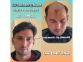 hair-wig-hair-patch-hair-extensions-small-0