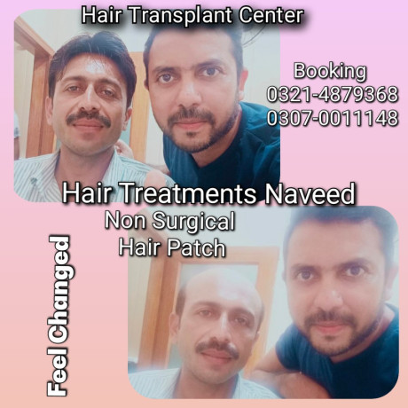 hair-wig-hair-patch-hair-extensions-big-6