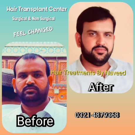 hair-wig-hair-patch-hair-extensions-big-2