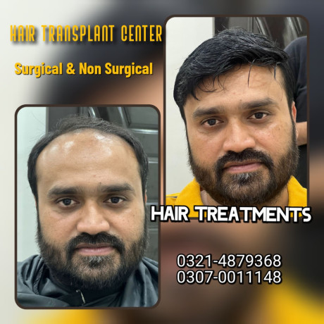 hair-wig-hair-patch-hair-extensions-big-5